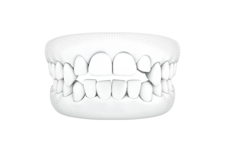 Resultado do tratamento ortodôntico com Invisalign